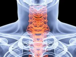 Corpectomía Vertebral Cervical Anterior