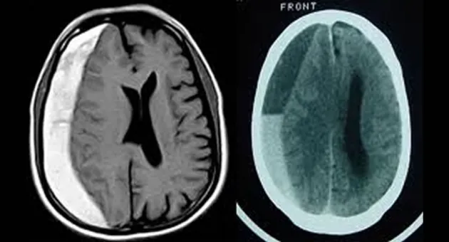 Hematoma Subdural Tijuana