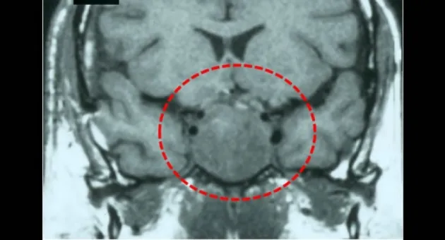 Tumor Hipófisis Tijuana