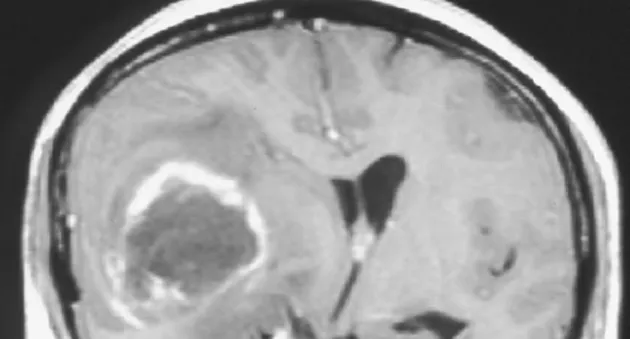 Tumor Cerebral Tijuana